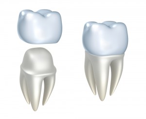 Crown and Bridges - illustration of Crown